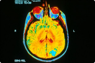 agy MRI