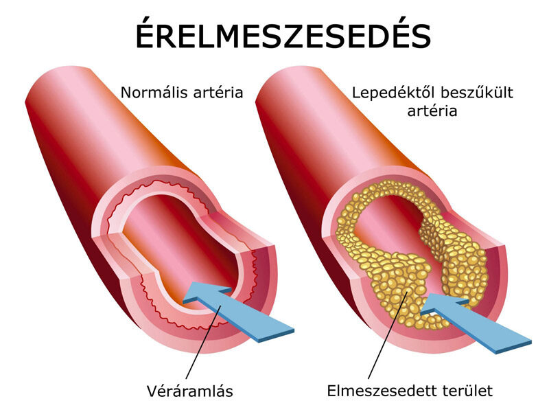 erelmeszesedes